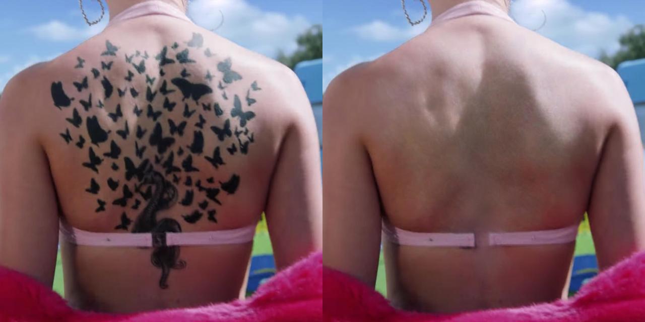 Tattoo remover example 5