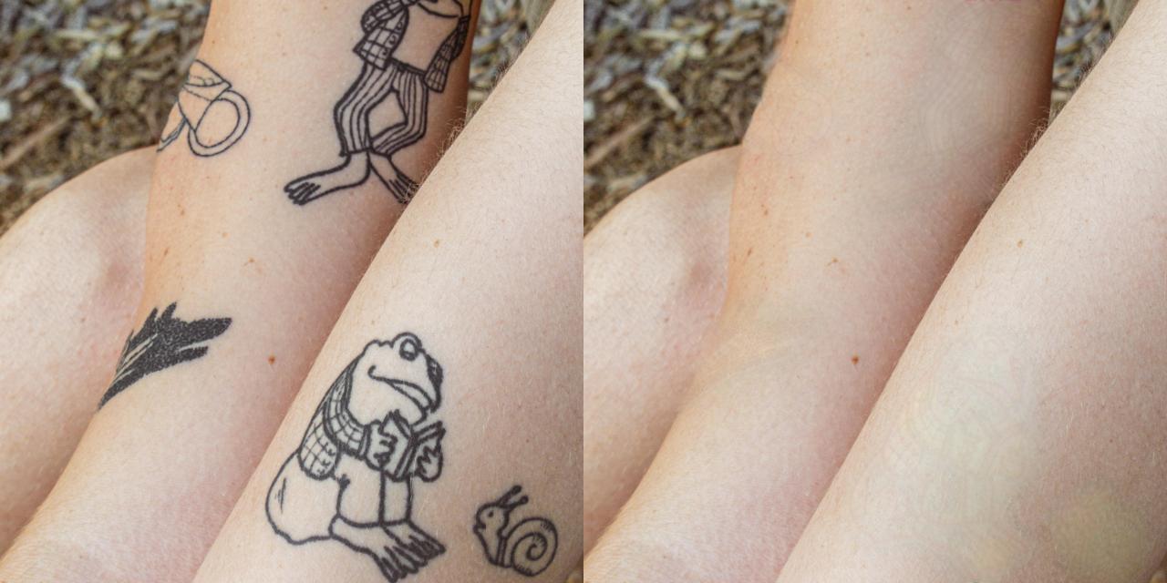 Tattoo remover example 6